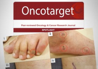 Szokujące nowe badanie łączące szczepienia na Covid-19 z rakiem znika z sieci.